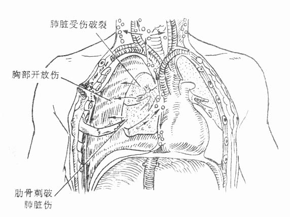 创伤性气胸