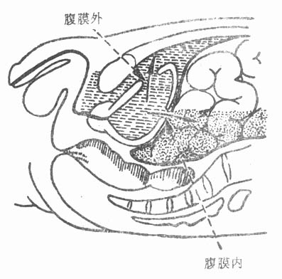破裂口均在无腹膜复盖的前壁或颈部,故外渗尿均在腹膜外膀胱周围(图6